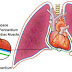 Pericardial Mesothelioma,symptoms of pericardial mesothelioma,Diagnosis