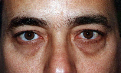 vitamin yang menghilangkan lingkaran hitam dibawah mata