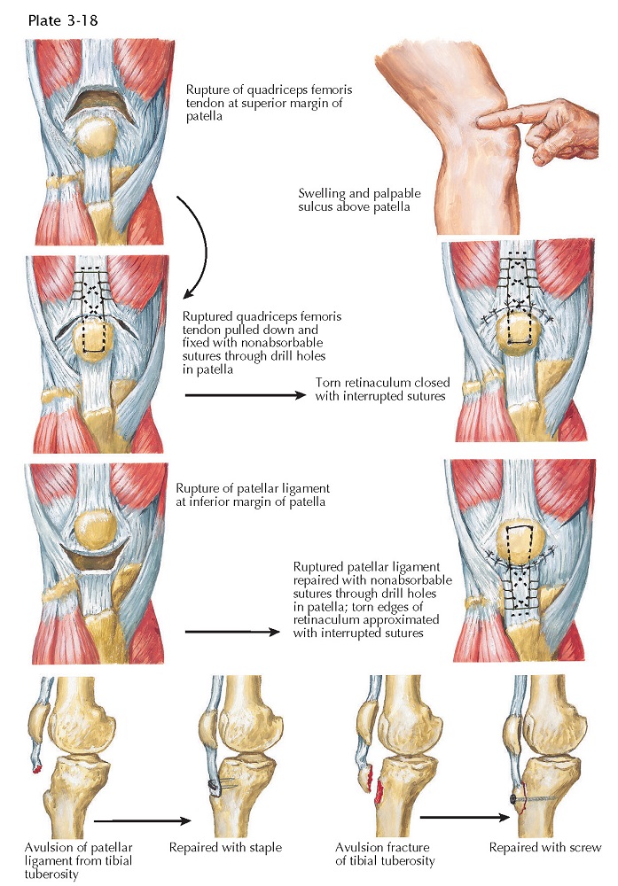 DISRUPTION OF QUADRICEPS FEMORIS TENDON OR PATELLAR LIGAMENT