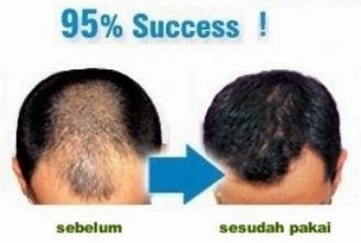 penumbuh rambut botak