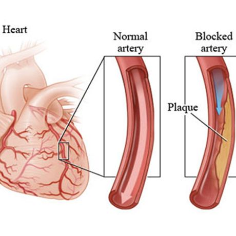  Causes Cardiovascular Disease