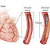 What are the Causes Cardiovascular Disease and the Symptoms to Observe