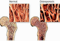 Osteoporosis Prevention