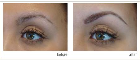 Eyebrow Tattoo in London, UK: Before and after eyebrow surgery