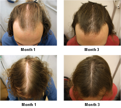 How To Regrow Hair On Your Temples : Alzheimer's Disease Symptoms