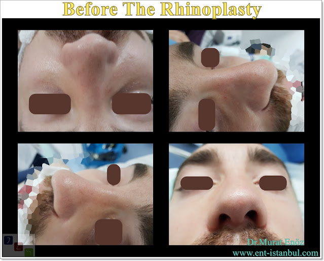 Natural Rhinoplasty in Men Istanbul, Turkey