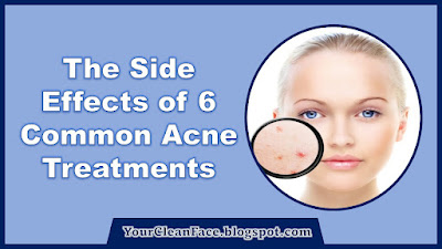 The Side Effects of 6 Common Acne Treatments