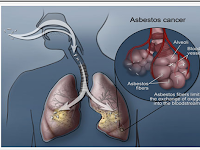 Mesothelioma Cancer : What is Mesothelioma Cancer and Can it Be Cured?
