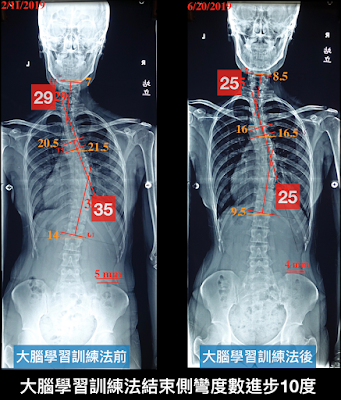 脊椎側彎矯正,脊椎側彎治療,脊椎側彎運動,脊椎側彎矯正成功, 大腦學習訓練側彎矯正法