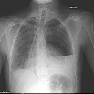 Pleura Effusion NIC NOC - Ineffective airway clearance