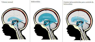 Resultado de imagem para cirurgia hidrocefalia