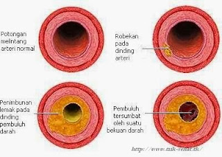 Mencegah Timbunan Lemak Di Arteri