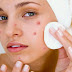 How to Remove Pimples Naturally