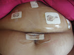 War wounds