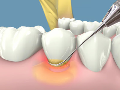 Tại sao cần phải cạo vôi răng?