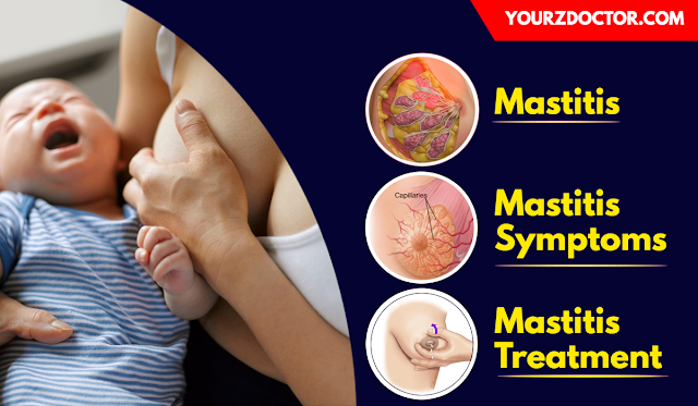 Mastitis Symptoms and Treatment