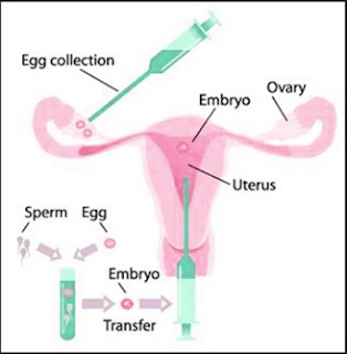 What Does IVF Treatment Involve