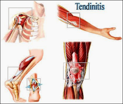 CÓMO ALIVIAR LA TENDINITIS CON REMEDIOS CASEROS