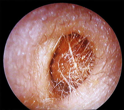 kotoran telinga cerumen ear wax