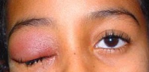 Kelopak Mata Bengkak dan Sakit Gatal Sebelah dan Penyebab 