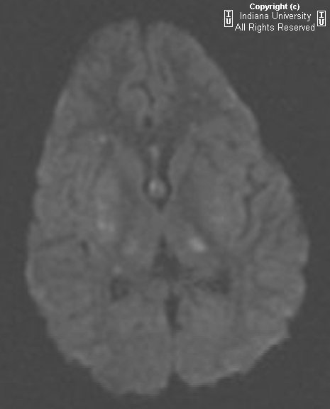 Hemolytic Uremic Syndrome. Hemolytic uremic syndrome