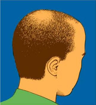 Causes Hair Loss, Baldness