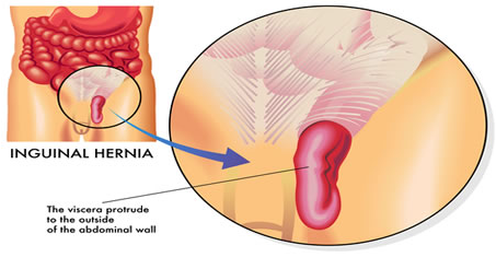 mengatasi hernia, mengobati hernia, cara mengobati hernia, cara mengatasi hernia