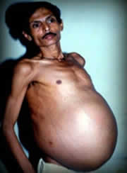 Bhagat twin brother in his stomach