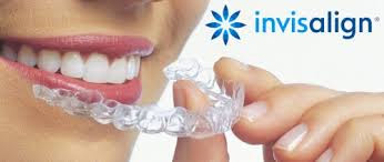 Invisalign là phương pháp niềng răng hiện đại nhất đang được áp dụng tại Kim Dentistry