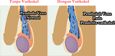 Obat Herbal Varikokel Tanpa Efek Samping