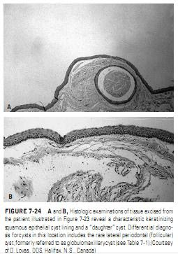 CYSTS OF THE JAWS AND BENIGN ODONTOGENIC TUMORS Cysts of the Jaw