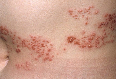 Bệnh zona (Herpes Zoster)