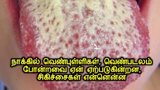 Naakkil venpulligal, venpadalam en erpaduginrana, ivatrukku sikicchaigal ennenna, venpulli treatment in tamil