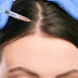 Is Mesotherapy Effective For Hair Loss?