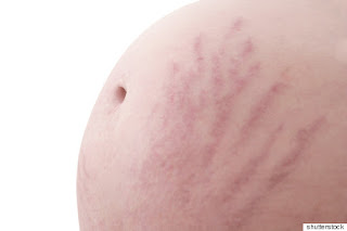 pregnancy marks