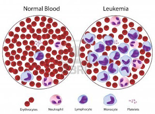 Types Of Most Common Cancer,Early Skin Cancer,Primary Liver Cancer,Most Common Cancer Types