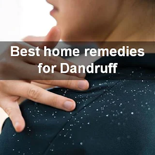 Home remedies for dandruff quickly remove dandruff