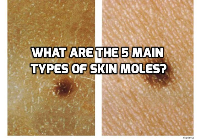 Different types of skin moles have different characteristics and properties. It is therefore important to be aware of the main types of skin moles that exist. Click on above image to Read on to find out more.