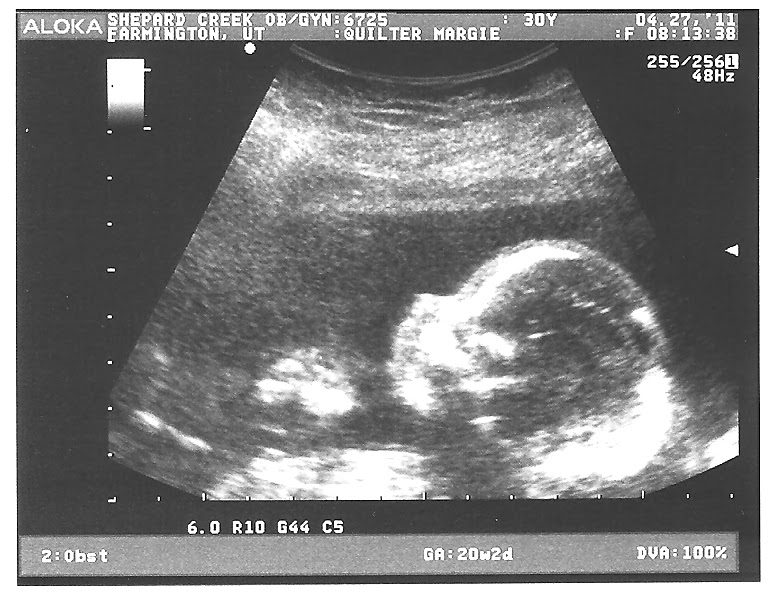 3d ultrasound 20 weeks boy. 3d ultrasound 20 weeks boy.