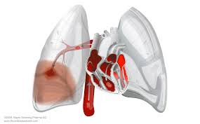 A embolia pulmonar (PE ) é uma condição extremamente comum e altamente letal que é uma das principais causas de morte em todas as faixas etárias .