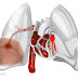 Embolia Pulmonar - Sintomas e causas