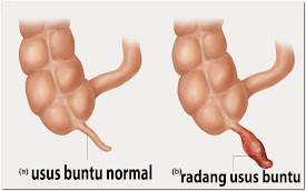 obat radang usus buntu herbal