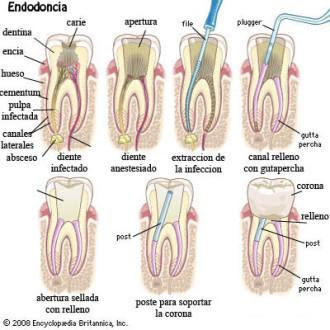 ¿Qué es una endodoncia y en qué consiste?