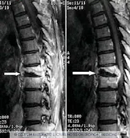 Tuberculose da coluna