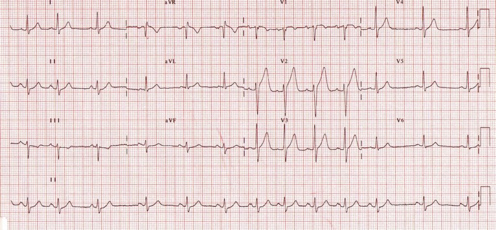 呼吸性竇性心律不整（respiratory sinus arrhythmia）