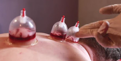 cupping therapy, cupping therapy benefits, cupping therapy points, blog, cupping therapy at home,cupping therapy near me, cupping therapy price, wet cupping hijama,hijama therapy, cupping uses, cupping benefits