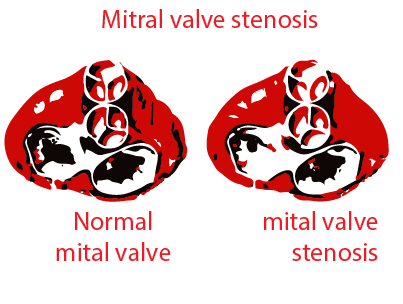 Rheumatic fever