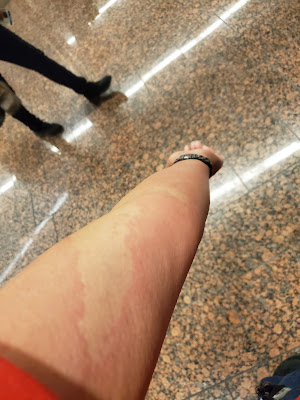 skin pattern of allergic to cold. Itchy red skin