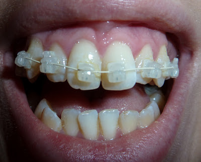 A front on photograph of open teeth with upper ceramic fixed braces at day 0 of treatment