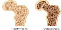 Osteoporosis